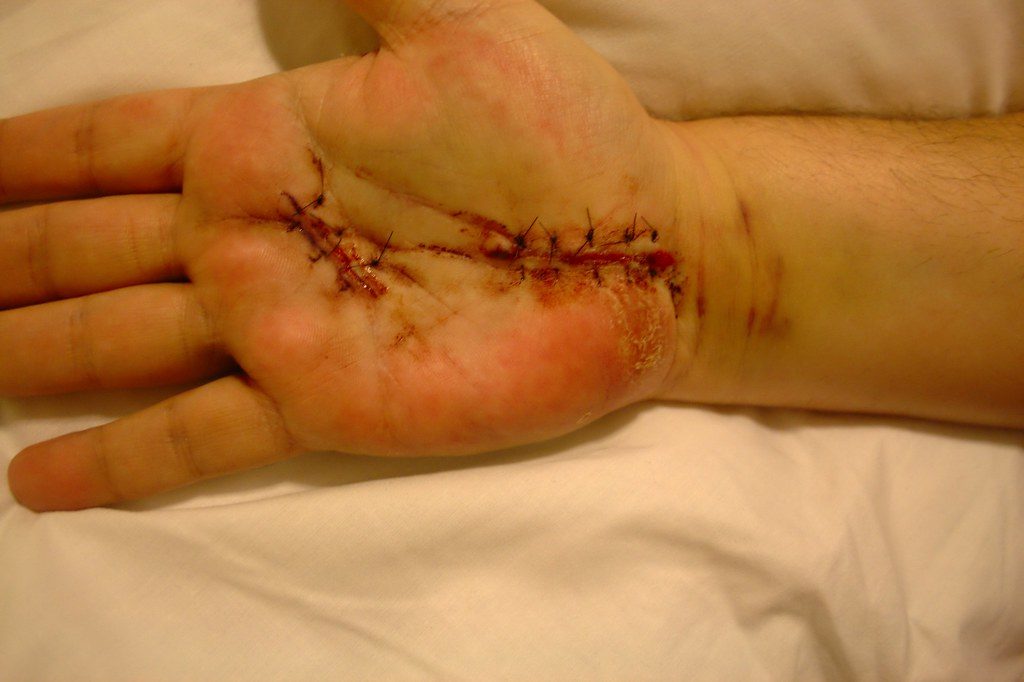 carpal tunnel massage, carpal tunnel rehab, carpal tunnel surgery